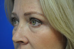 Eyelid Surgery Before and After