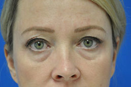 Eyelid Surgery Before and After