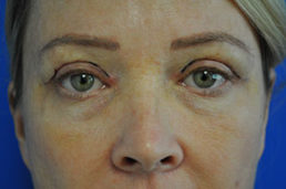 Eyelid Surgery Before and After
