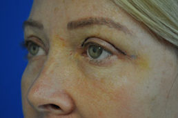 Eyelid Surgery Before and After