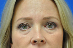 Eyelid Surgery Before and After