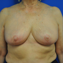 breast procedure after photo