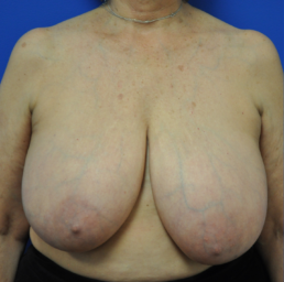 breast procedure before photo