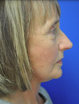 facelift after photo