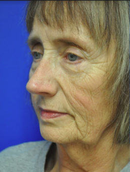 facelift before photo