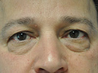 eyelid surgery before photo