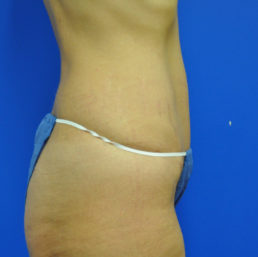 tummy tuck after photo