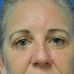 upper and lower eyelid surgery after photo