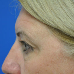 upper and lower eyelid surgery before photo