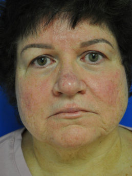 facelift before photo