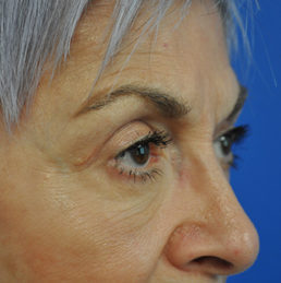 eyelid surgery after photo