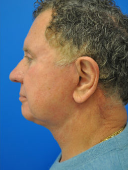 facelift after photo