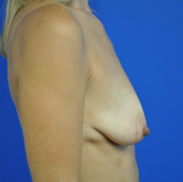 combination breast lift augmentation before photo