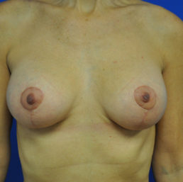 combination breast lift augmentation after photo