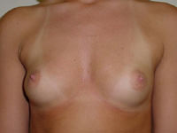 breast augmentation before photo