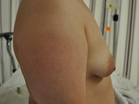 breast augmentation before photo