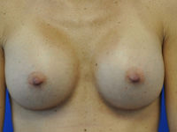 breast augmentation after photo