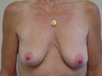 combination of breast augmentation and breast lift before photo