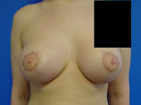 combination of breast augmentation and breast lift after photo