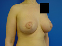 combination of breast augmentation and breast lift after photo
