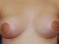 complex primary breast augmentation after photo