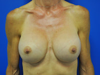 Revisional & Corrective Breast Augmentation after photo