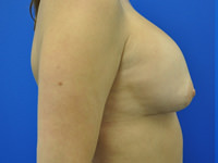 Revisional & Corrective Breast Augmentation before photo
