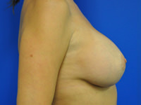 Revisional & Corrective Breast Augmentation after photo