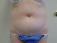 liposuction before photo