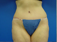 abdominoplasty tummy tuck after photo
