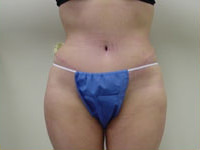 abdominoplasty tummy tuck after photo
