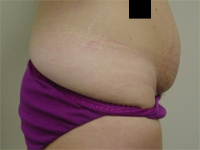 abdominoplasty tummy tuck before photo