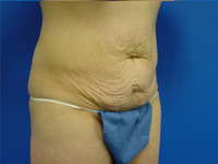 abdominoplasty tummy tuck before photo