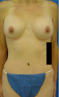 breast augmentation and abdominoplasty after photo