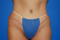 an abdominoplasty with flank liposuction after photo