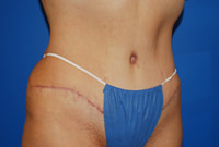 an abdominoplasty with flank liposuction after photo