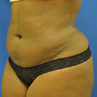 buttock augmentation after photo