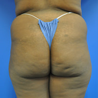 buttock augmentation before photo