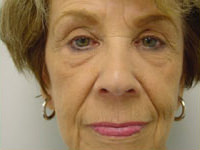 facelift, browlift, upper and lower eyelid lift before photo
