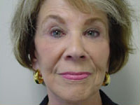facelift, browlift, upper and lower eyelid lift after photo