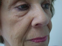 facelift, browlift, upper and lower eyelid lift before photo