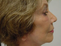 facelift, browlift, upper and lower eyelid lift after photo