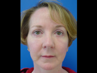 mini facelift and eyelid surgery after photo