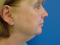 mini facelift and chin fat removal before photo
