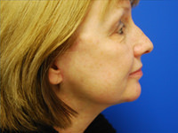 mini facelift and chin fat removal after photo