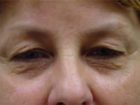 upper and lower eyelid lift before photo