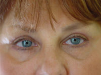 upper and lower eyelid lift after photo
