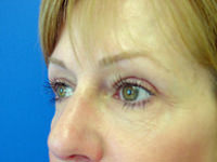 Eyelid surgery after photo