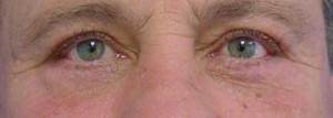 upper and lower eyelid surgery after photo
