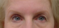 brow lift and eyelid surgery before photo